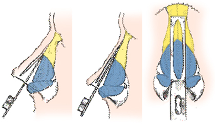 OSTEOTOME SHARPNESS