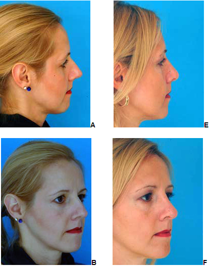 rhinoplasty New Jersey