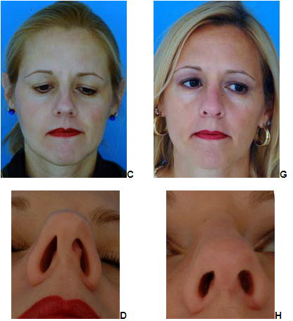 rhinoplasty New Jersey