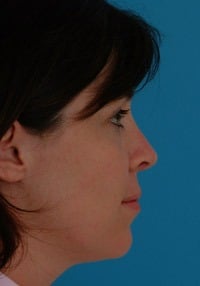 Revision Rhinoplasty