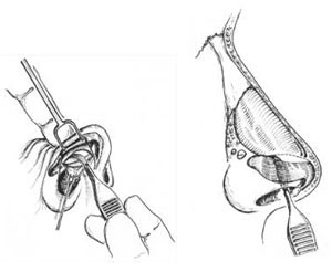 cartilage-splitting 01
