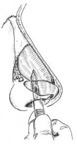 cartilage-splitting 02
