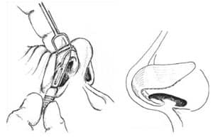 cartilage-splitting 03