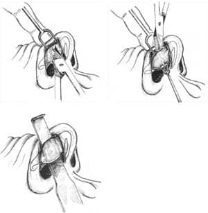 cartilage-splitting 04