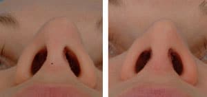 cartilage-splitting 07