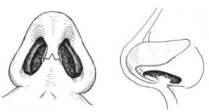 cartilage-splitting 09