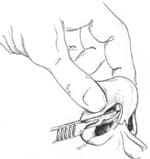 cartilage-splitting 11