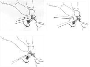 cartilage-splitting 12