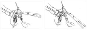 cartilage-splitting 13