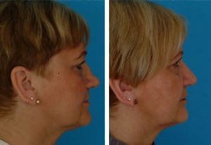 cartilage-splitting 16