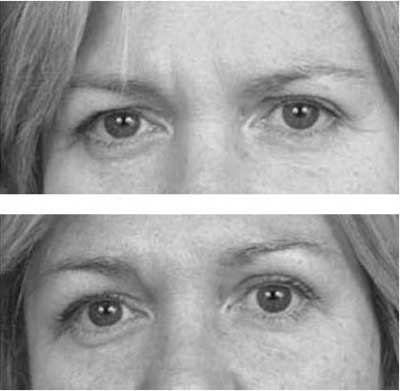 Rhinoplasty and Sinus Surgery