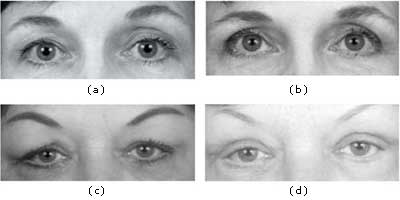 Rhinoplasty and Sinus Surgery