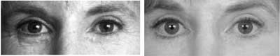 Rhinoplasty and Sinus Surgery