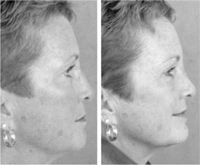 Rhinoplasty and Sinus Surgery