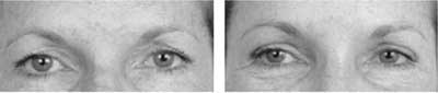 Rhinoplasty and Sinus Surgery