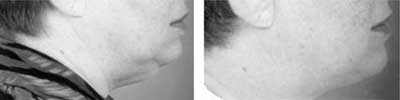 Rhinoplasty and Sinus Surgery