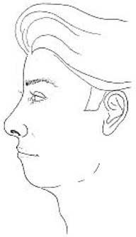 Chin Implant 01
