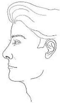 Chin Implant 02