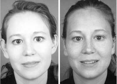 Rhinoplasty and Sinus Surgery