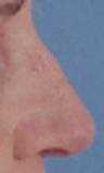 Becker Rhinoplasty New Jersey