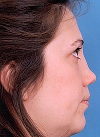 Becker Rhinoplasty New Jersey