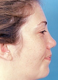 Becker Rhinoplasty New Jersey