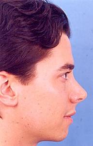 Becker Rhinoplasty New Jersey