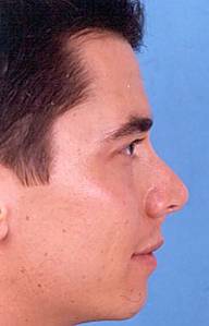 Becker Rhinoplasty New Jersey