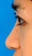 Ethnic Rhinoplasty Before & After New Jersey