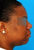 Asian Rhinoplasty Before & After New Jersey