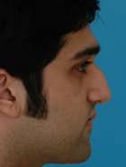 Asian Rhinoplasty Before & After New Jersey