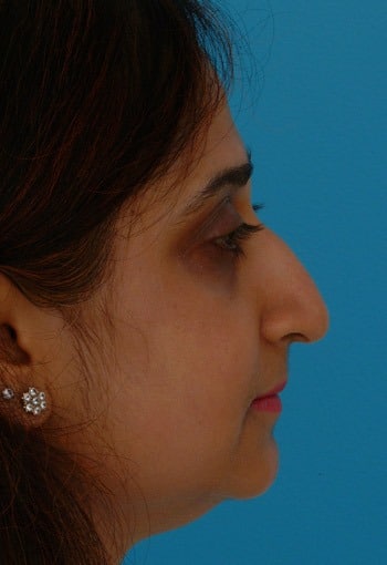 Asian Rhinoplasty Before & After New Jersey