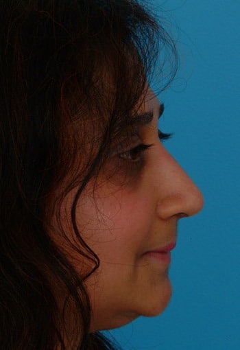 Asian Rhinoplasty Before & After New Jersey