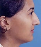 Asian Rhinoplasty Before & After New Jersey