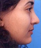 Asian Rhinoplasty Before & After New Jersey