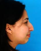 Asian Rhinoplasty Before & After New Jersey