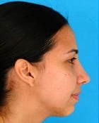 Asian Rhinoplasty Before & After New Jersey