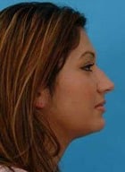 Asian Rhinoplasty Before & After New Jersey