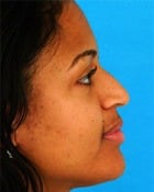 Asian Rhinoplasty Before & After New Jersey