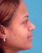 Asian Rhinoplasty Before & After New Jersey