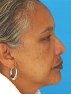 Asian Rhinoplasty Before & After New Jersey