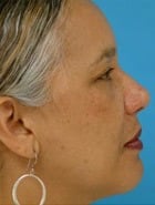 Asian Rhinoplasty Before & After New Jersey