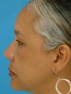 Asian Rhinoplasty Before & After New Jersey