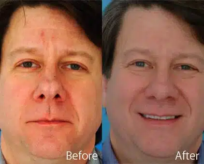 Before and After