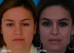 Bulbous Tip Before and After Photos in Sewell, NJ, Patient 7008