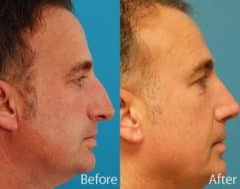 Droopy Nose Before and After Photos in Sewell, NJ, Patient 7063