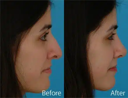 Droopy Nose Before and After Photos in Sewell, NJ