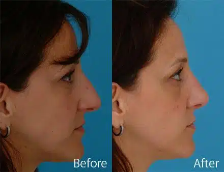 Droopy Nose Before and After Photos in Sewell, NJ, Patient 7067