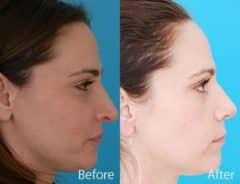 Droopy Nose Before and After Photos in Sewell, NJ, Patient 7069