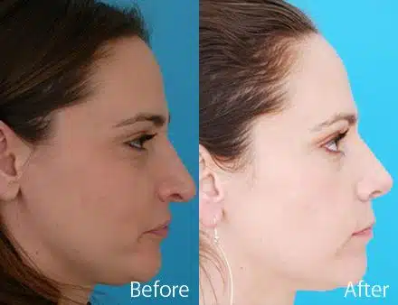 Droopy Nose Before and After Photos in Sewell, NJ, Patient 7069